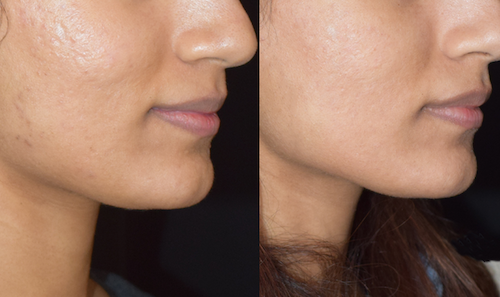 acne scarring treatment before after oakville mississauga 1